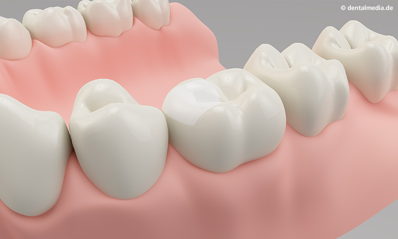 Zahnfüllungen : Einfache Kunststoff-Füllung